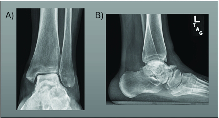 figure-results-1 Dual X-ray images of human ankle; frontal and lateral views for fracture assessment.