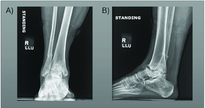 figure-results-10 Ankle X-ray diagram, frontal and lateral views, for orthopedic analysis.
