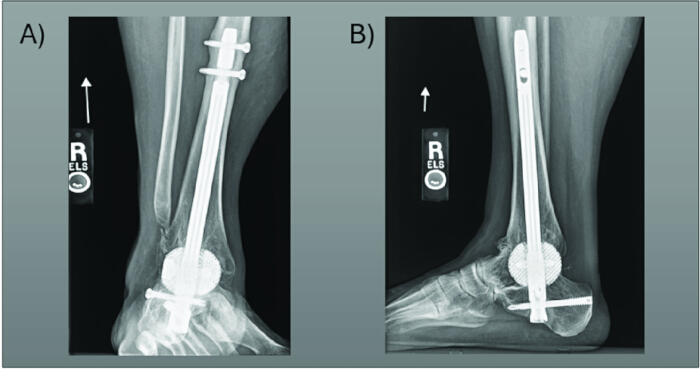 figure-results-11 Intramedullary nail fixation; X-ray images; orthopedic procedure; fracture stabilization; side views.