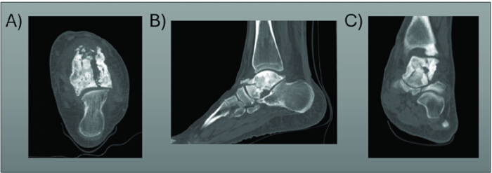 figure-results-2 MRI scans of foot anatomy, displaying transverse, lateral, and axial views for diagnostic analysis.