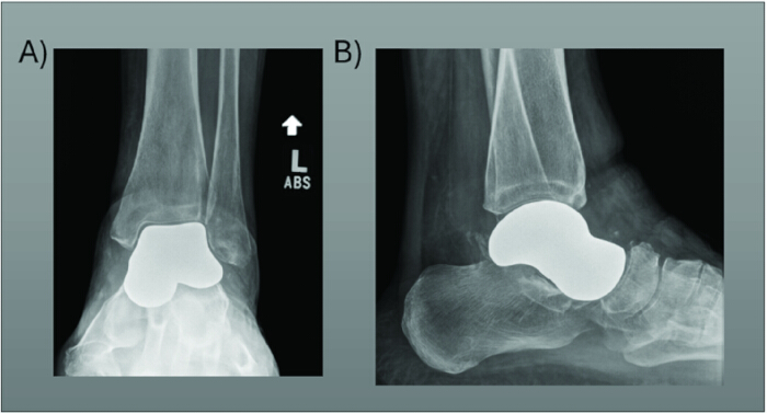 figure-results-3 X-ray analysis; ankle prosthesis placement; two angles; orthopedic surgery result; medical imaging.