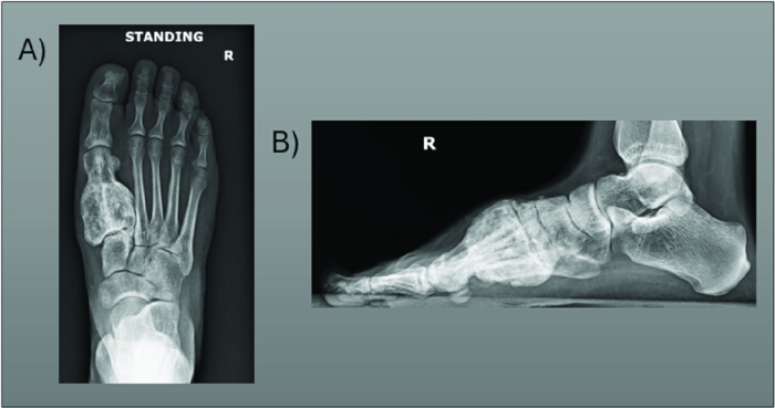 figure-results-4 X-ray foot images, frontal and lateral views, showing bone structure for medical analysis.