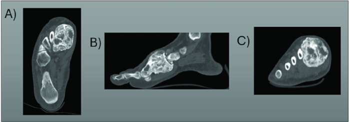 figure-results-5 CT scan showing foot bones; three views: axial, sagittal, and coronal. Radiology examination.