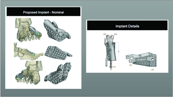 figure-results-6 Medical implant design process; 3D model diagram with structural details and proposed configurations.