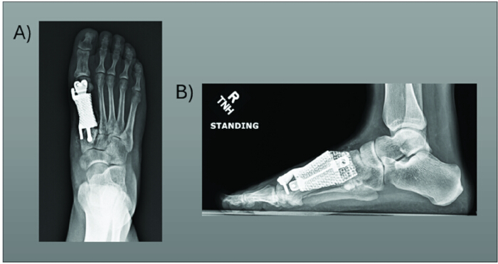 figure-results-8 X-ray showing foot implants post-surgery; A) dorsal view, B) lateral view; medical analysis.