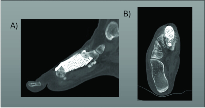 figure-results-9 CT scan images showing bone grafts in an orthopedic procedure; axial and sagittal views.