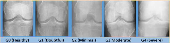 Knee osteoarthritis grading diagram showing X-ray progression from healthy (G0) to severe (G4).