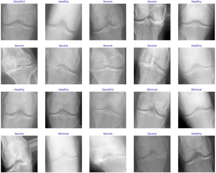figure-protocol-5 Knee X-ray series for osteoarthritis grading; diagnostic radiography results, varying severity levels.