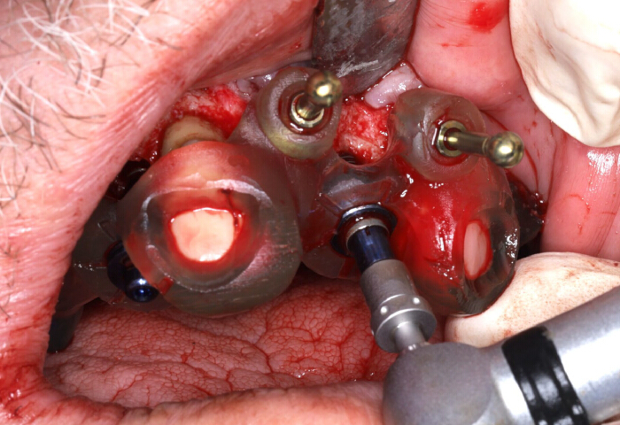 figure-results-3 Dental surgery technique; guided implants; oral surgery procedure; dental implant placement.