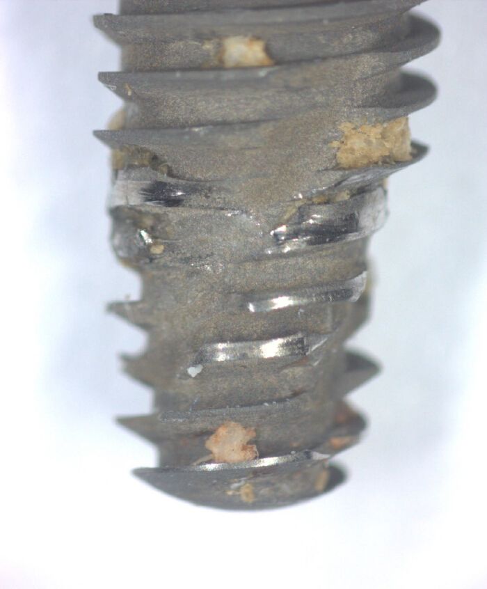 figure-results-4 Dental implant buildup, microscope image; surface analysis, material study, implant corrosion.