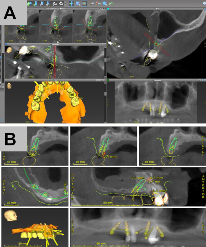 figure-results-5 Dental implant planning, CT scan diagram, 3D jaw representation, surgical site analysis, prosthetic fitting.