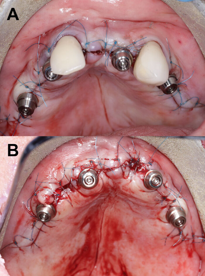 figure-results-6 Dental implant placement, surgical procedure showing abutments and sutures, oral surgery techniques.