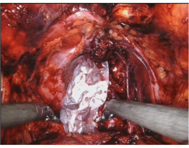 figure-results-3 Surgical procedure close-up, showing use of medical instruments in a tissue incision.