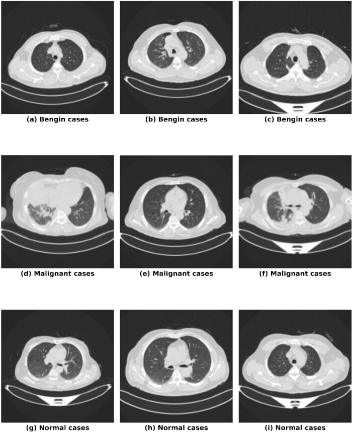CT scan diagram comparing benign, malignant, and normal lung cases for diagnostic analysis.