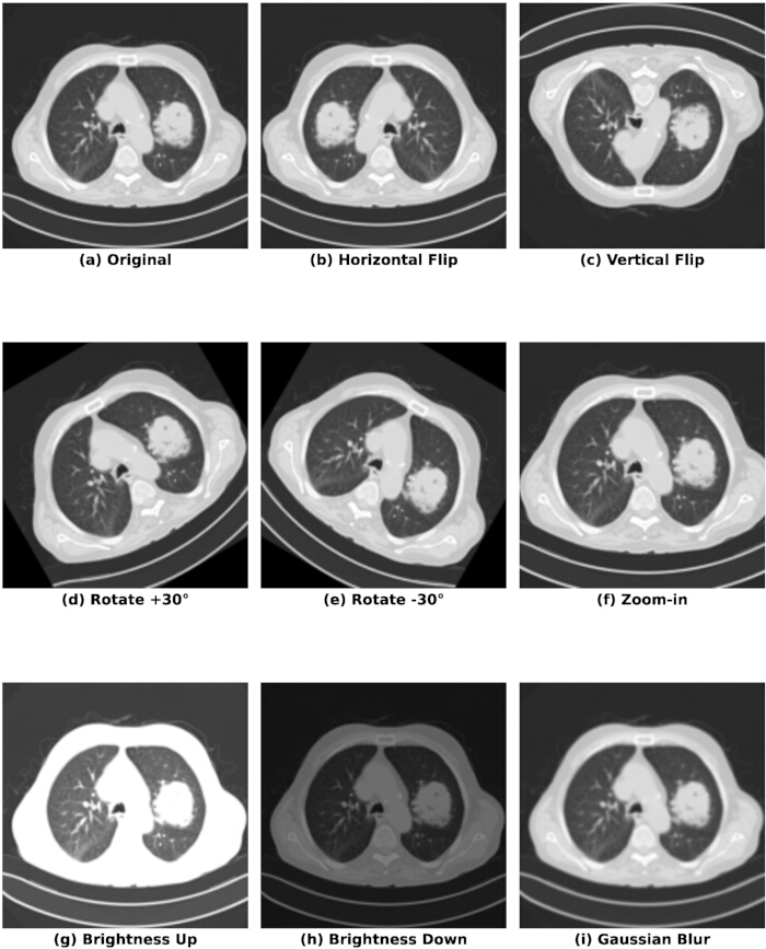 figure-protocol-2 CT scan image processing: transformations and adjustments, includes rotation, flipping, and brightness.