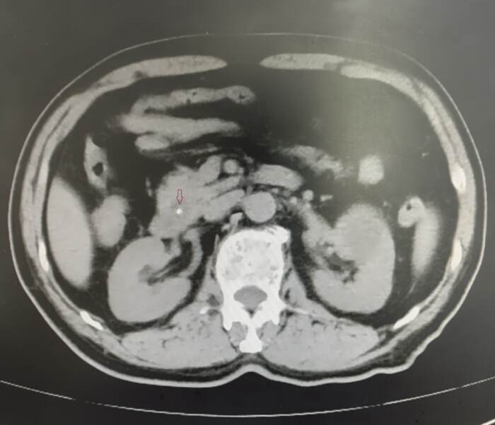 CT scan diagnostic image showing abdominal cross-section, highlighting kidney stones.