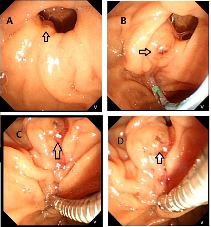 Endoscopic procedure for gastric polyp removal sequence; medical technique; clinical images.