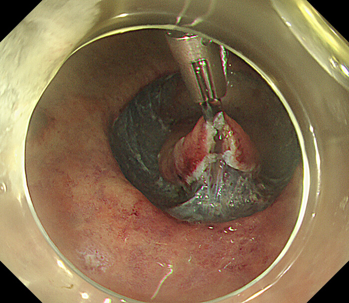 figure-protocol-10 Endoscopic surgical procedure diagram, highlighting tissue manipulation and resection technique.