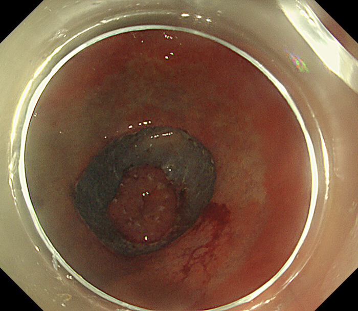 figure-protocol-5 Colonoscopy result showing a lesion in the large intestine, diagnostic medical imaging.