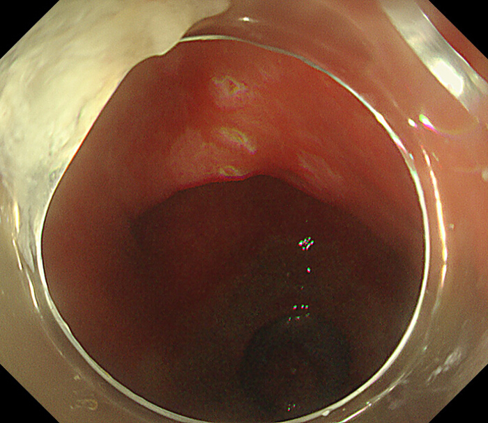 figure-protocol-6 Ulcerated gastrointestinal mucosa; endoscopy image; diagnostic, clinical gastroenterology.