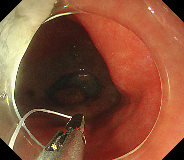 figure-protocol-7 Endoscopic biopsy procedure inside the colon; colon cancer detection, diagnostic image.