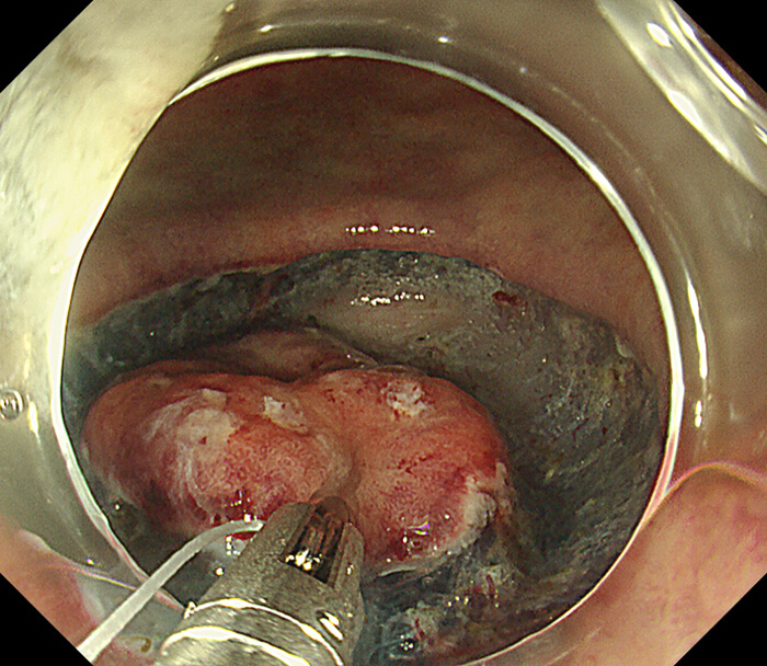 figure-protocol-8 Endoscopic procedure on gastric lesion; medical examination, diagnostic imaging, gastroenterology study.