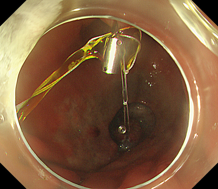 figure-protocol-9 Endoscopic biopsy procedure; tissue sample collection; medical instrument; endoscopy visualization.