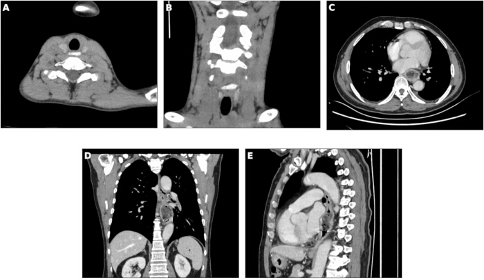 figure-results-1 CT scan images; axial and coronal views of neck, chest, and abdomen; diagnostic imaging.