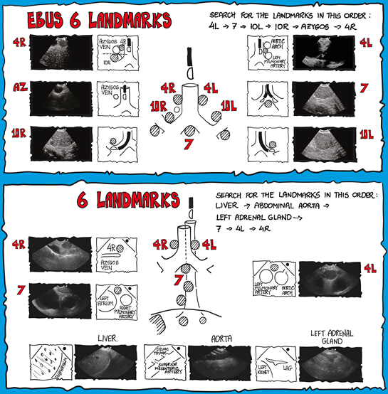 figure-protocol-3 Endobronchial ultrasound (EBUS) landmark diagram with ultrasound images; lymph node identification.