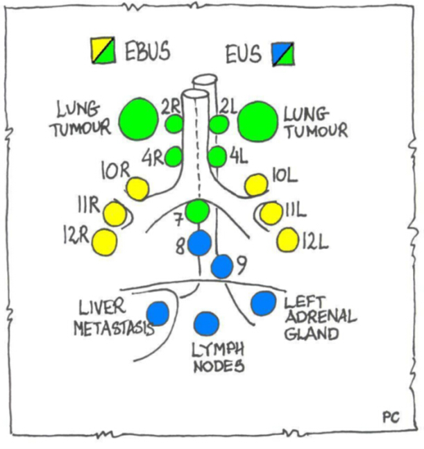 figure-protocol-4 Lung lymph node biopsy diagram, EBUS and EUS, lymph node locations for tumor detection.