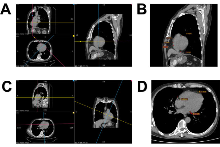 figure-protocol-1 CT scan analysis with tumor measurement annotations; diagnostic radiology study.