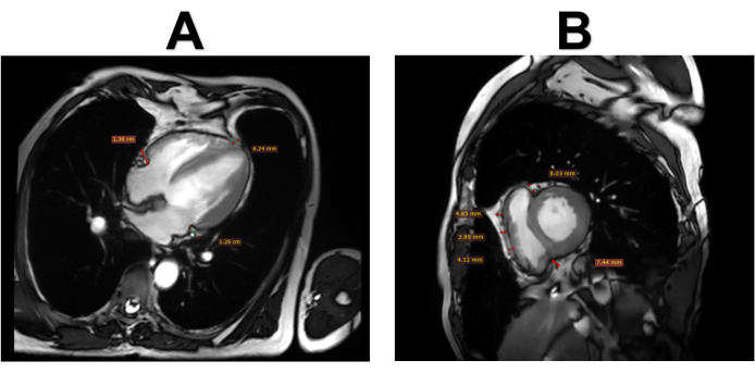 figure-protocol-2 MRI heart cross-section analysis; measurements highlighted; anatomical study comparison, medical imaging.