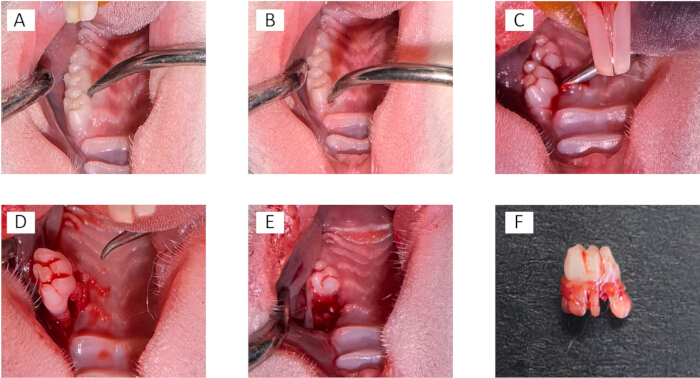 Dental extraction sequence, oral surgery method, post-operative result, educational keyword.