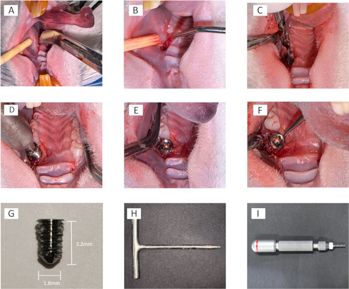Surgical procedure for dental implant placement, sequence of images showing step-by-step process.