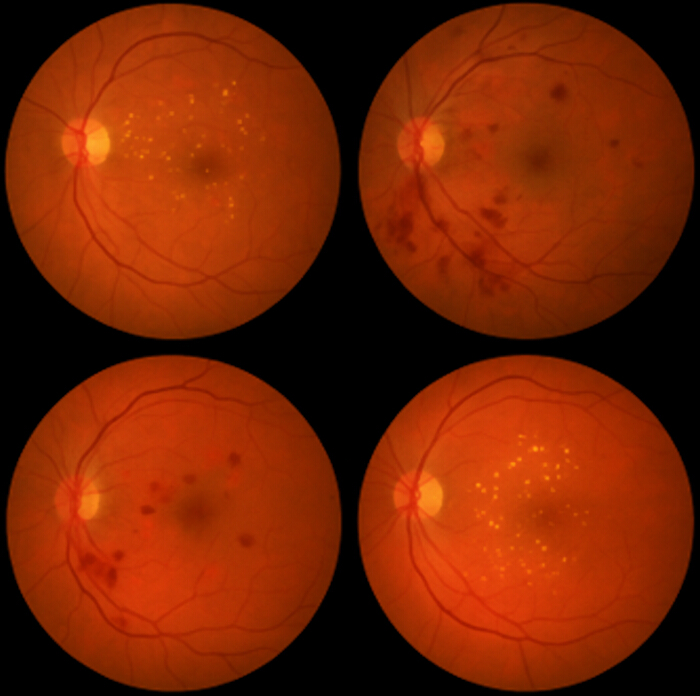 figure-introduction-1 Retinal examination, ophthalmic diagnosis, comparative images of potential retinal conditions.