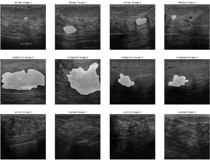 figure-protocol-1 Breast ultrasound images: benign, malignant, normal. Tumor detection, diagnostic imaging chart.