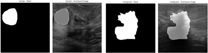 figure-protocol-5 Benign and malignant tumor segmentation, masked and overlaid ultrasound images, diagnostic analysis.