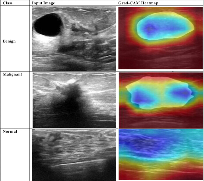 figure-protocol-22 Ultrasound image analysis with Grad-CAM heatmaps; benign, malignant, normal tissue comparison.