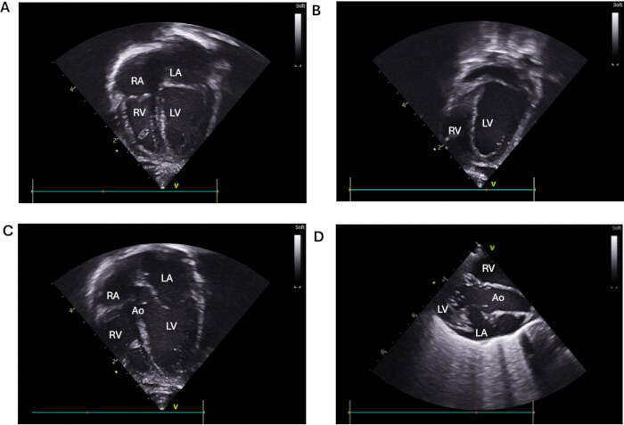 figure-protocol-3 Cardiac ultrasound images; heart chambers labeled; echocardiography; medical imaging study.