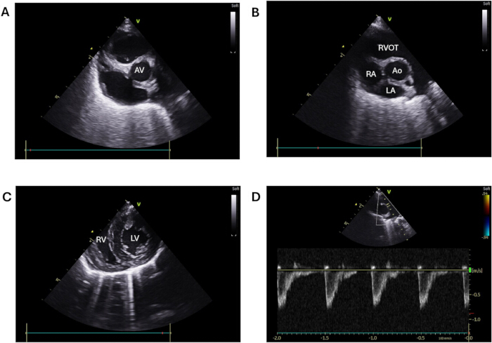 figure-protocol-4 Cardiac ultrasound diagrams and echocardiographic Doppler results showing heart chamber analysis.