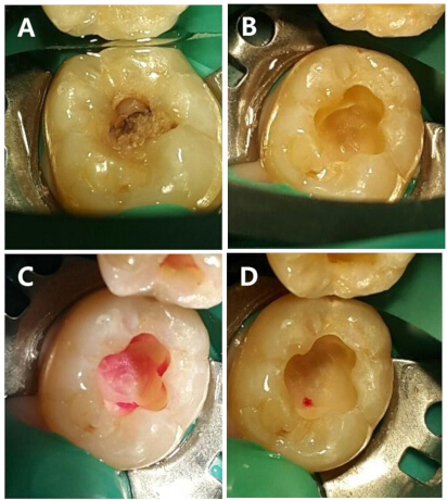 figure-protocol-2 Dental cavities treatment process in molars; series of images showing caries removal and cleaning.