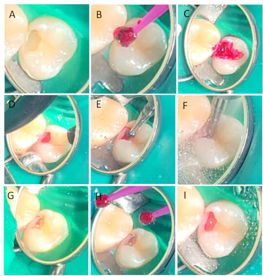 figure-protocol-3 Dental restoration process; nine-panel diagram showing cavity treatment and filling application.