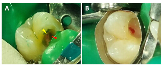 figure-protocol-4 Dental cavity examination, diagram highlighting decay areas using dental tools and isolation methods.