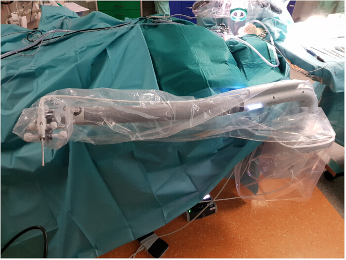 Surgical robotic arm setup in sterile environment for precise medical procedures.