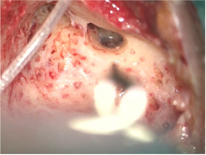 Surgical endoscopy image displaying bone tissue exposure and medical procedure setup.