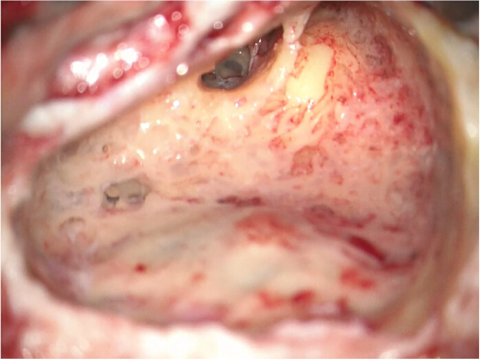 Surgical view of middle ear infection, displaying inflamed tissue, otoscopy findings.