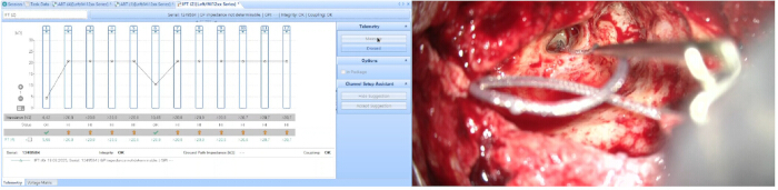 Surgical procedure with telemetry data chart; medical equipment for neurosurgery visualization.
