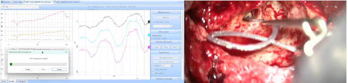 Surgical procedure with data graph showing real-time brain activity analysis using spectroscopy software.