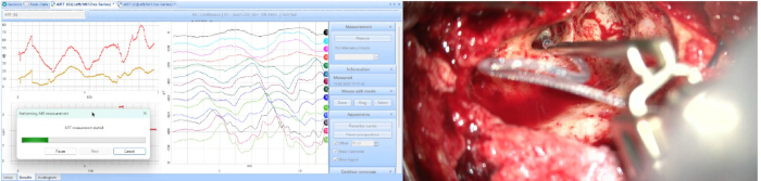 Spectral analysis graph with surgical setup; data acquisition in spectral fitting process.
