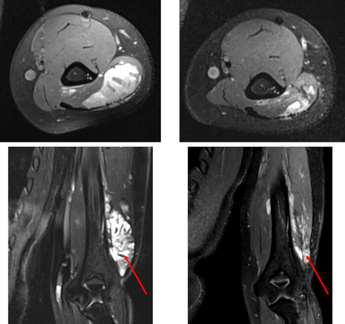 MRI scan showing leg tumor identification; axial and sagittal views with highlighted area.